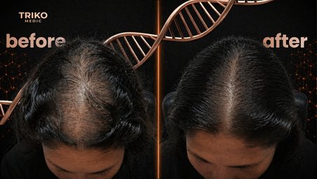 Resultado exitoso de recuperación de cabello en paciente femenina con efluvio telógeno